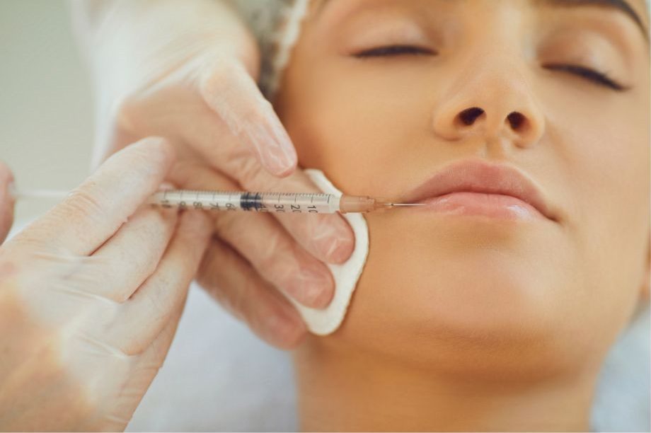 Lippenunterspritzung mit Hyaluron für vollere Lippen